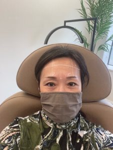 Asian American woman wearing a face mask with white markings on her face to guide a nurse for Botox injections.